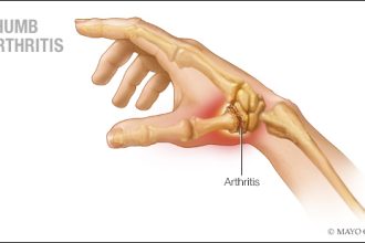 Conquer Thumb Arthritis: Mayo Clinic’s Quick Guide to Pain Relief!