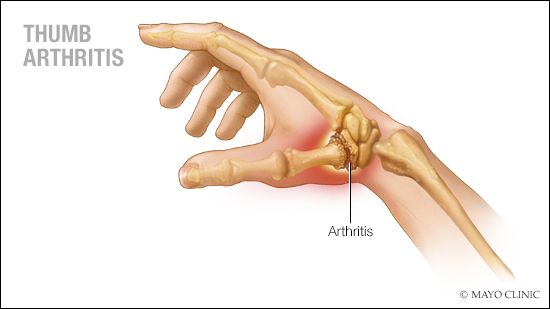 Conquer Thumb Arthritis: Mayo Clinic’s Quick Guide to Pain Relief!