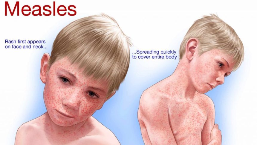 Shielding America: The Power of Vaccination in Stopping Measles Outbreaks