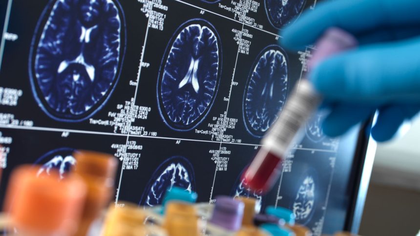 Promising Advances in Alzheimer’s Blood Tests: What You Need to Know About the Journey Ahead!