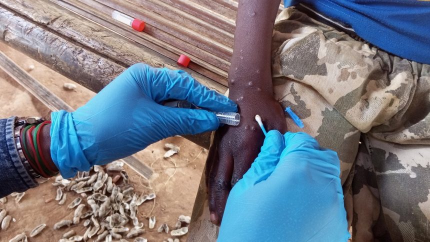 Mpox Strikes Again: Unpacking the Global Health Emergency