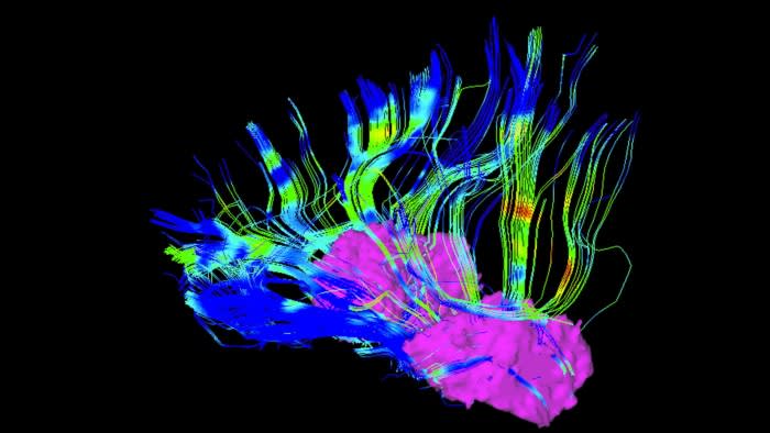 Revolutionary Implants Offer Hope: How Brain Activity Monitoring is Transforming Parkinson’s Treatment