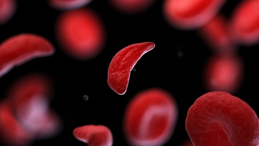 Revolutionary ‘Low-Intensity’ Blood Stem Cell Transplants Show Promise for Lung Health in Sickle Cell Patients!