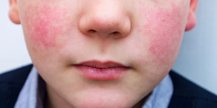 CDC Sounds the Alarm: ‘Slapped Cheek’ Virus on the Rise Across Europe and the US!