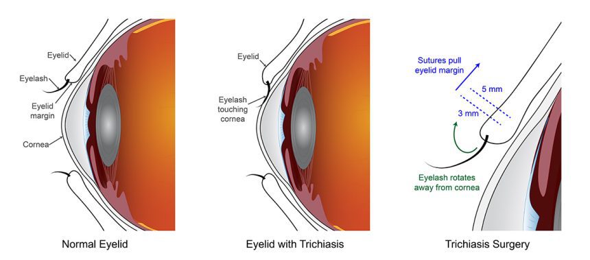 Revolutionary Findings: Two Surgeries Offer Equal Hope in Treating Blinding Eyelid Condition!